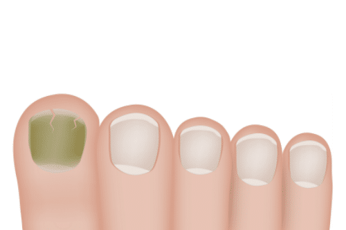 Understanding Green Nail Stains The Nail Lady