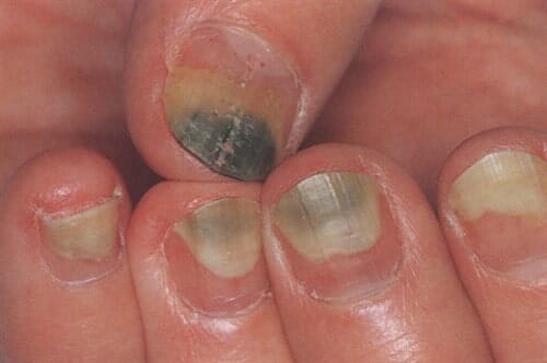 Treatment How To Get Rid Of Green Nail Fungus